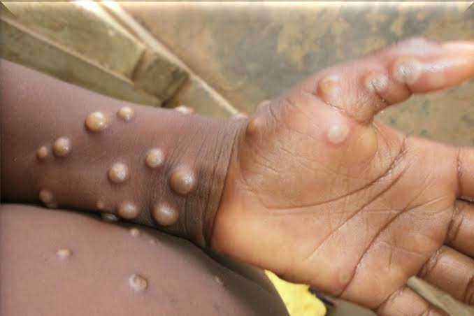 WHO Launches Emergency Response as Mpox Outbreak Worsens in DRC